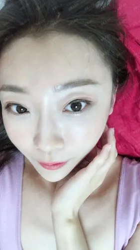 自体脂肪填充第15天