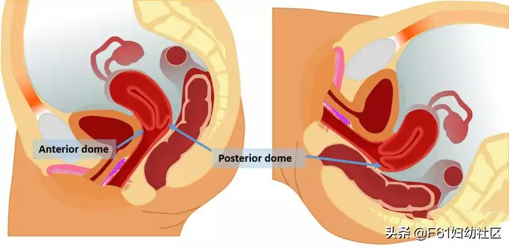 后穹窿 女性阴道穹隆解剖和作用