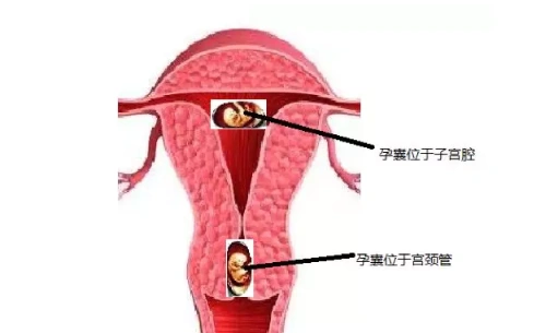 宫颈妊娠治疗难度大吗宫颈妊娠妇科检查症状