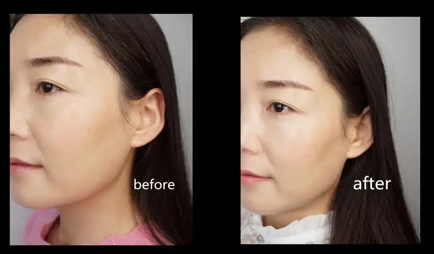 命c美白精华液两周前后肤色对比,   若不是保存了使用之前的照片的话