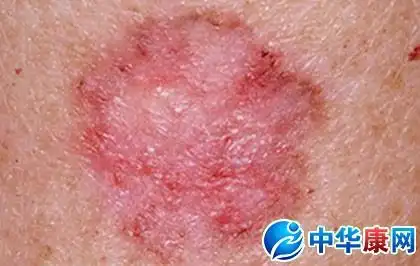皮肤癌早期症状图片