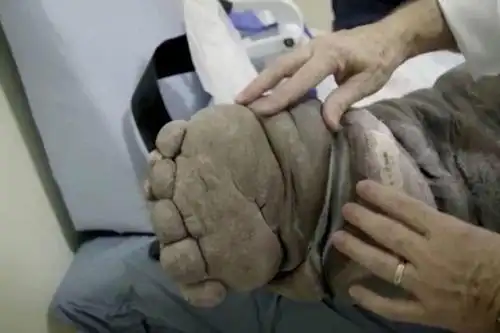 走路都成困难,"真凶"让人害怕又无奈|左腿|变异|象皮肿_新浪新闻