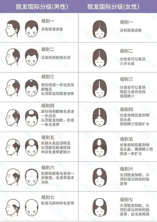 脱发等级对照表
