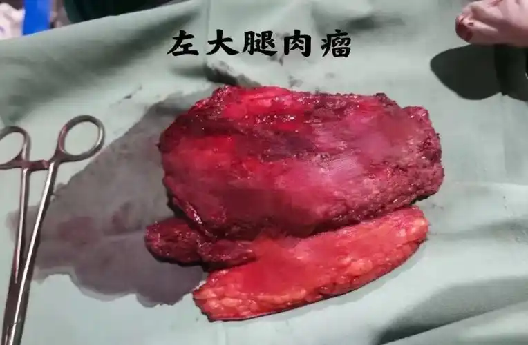 一例横纹肌肉瘤晚期患者的经典案例分享_横纹肌肉瘤_横纹肌肉瘤治疗