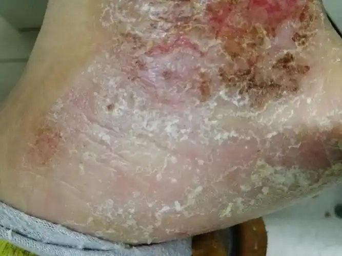 近两年左侧内踝下部皮肤反复溃烂,这是什么皮肤病
