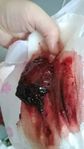 我是胎盘粘连吗?小孩出来后,一个医生问另一个医生,她做过流产吗?