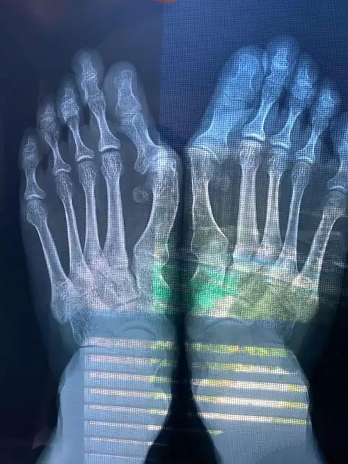 陈圣英分析拇外翻矫正削骨不是关键矫正才是关键