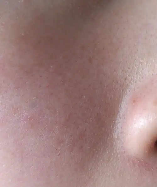 我皮肤属天然敏感混合性的,内干外油.我16岁.近期才想好好护肤.但是不