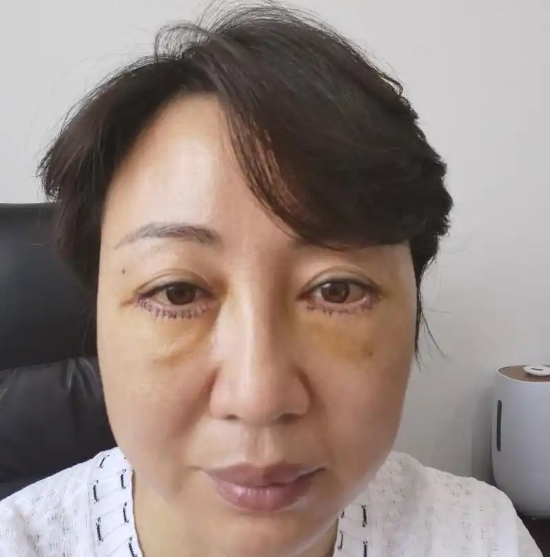 46岁"最后一次做眼袋手术",淤青肿胀不敢认,术后18天大变样!