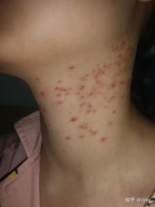 马拉色菌毛囊炎的治疗史