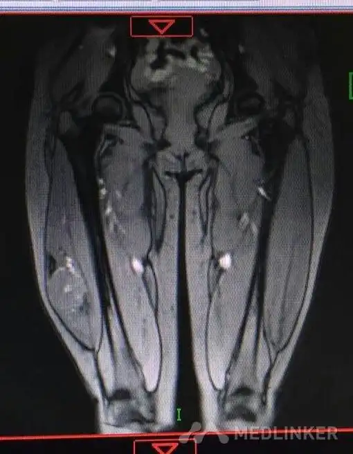 随访 讨论腺泡状软组织肉瘤好发于青春期女性,多位于四肢深部肌肉或