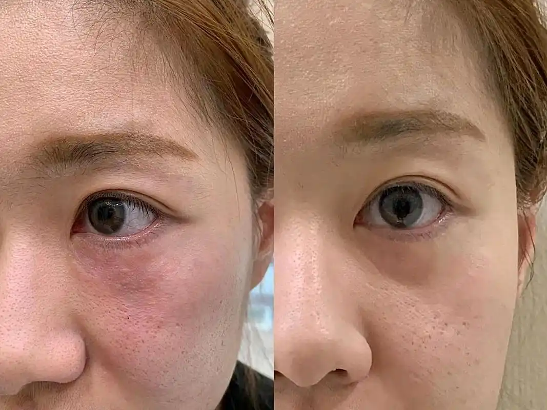 5ml ,嗨体去眼纹嗨体填泪沟嗨体眼睛手打眼周细纹 嗨体祛颈纹嗨体1.