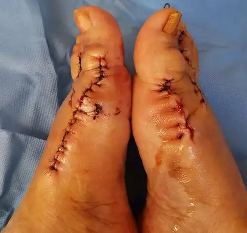 骨六科重度拇外翻并第2趾交叉趾畸形的治疗