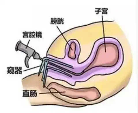 手术过程顺利成功保留输卵管术中的发现印证了术前的判断,小莹的宫