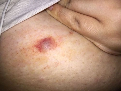 乳头痒是怎么回事乳头痒是怎么回事男