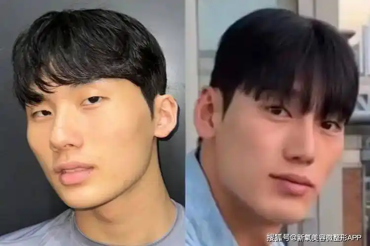 比如爱豆李艺谭就用几十次手术把大饼脸捏成狐狸颜,用实际行动诠释了