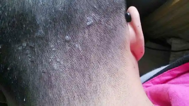 头皮牛皮癣,又痒,又是满头头皮屑,怎么治疗呢?