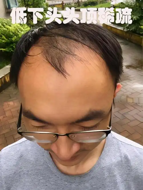 男生发际线高是一种什么样的体验脱发用药和植发有效果吗