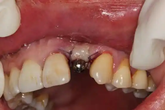 中心医院口腔种植牙权威专家揭秘种植牙全过程