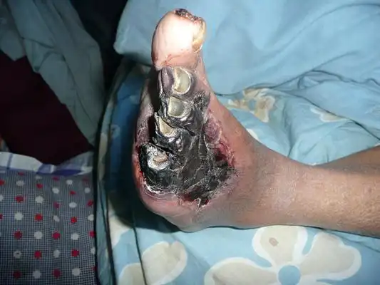 败血症图片 (84)