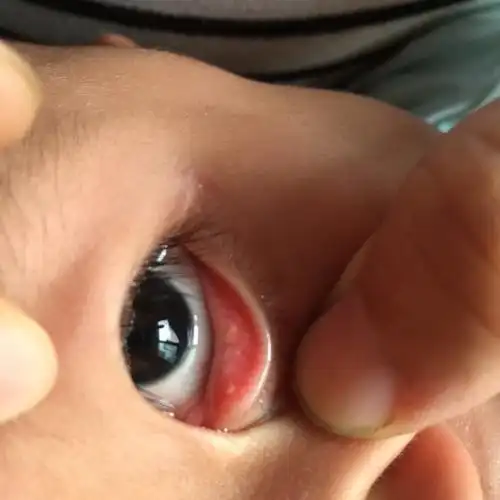 宝宝下眼皮内有白色小点是怎么回事啊?