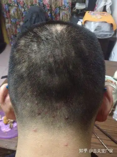 得了这种毛囊炎怎么办? 急! - 知乎