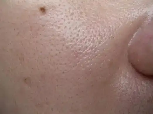毛孔粗大怎么办?6招拯救你的脸!
