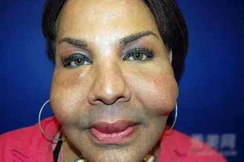 美丽不是你说了算 整容变毁容的惨痛代价