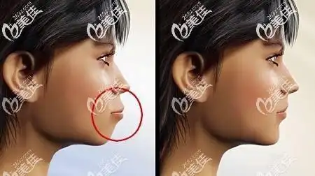 拔虎牙后嘴巴塌陷照片