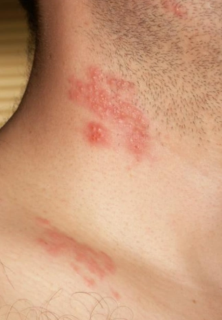 皮肤热毒图片 (30)_有来医生