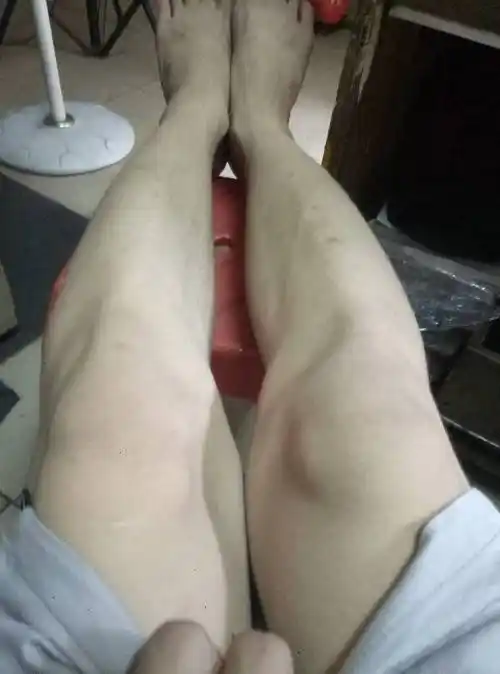 小腿骨向左右弯曲怎么办,感觉弯得过分了