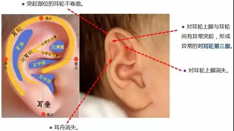 狒狒耳(猿耳,stahl07s ear):● 对耳轮发育不全,耳甲深大,耳舟及对