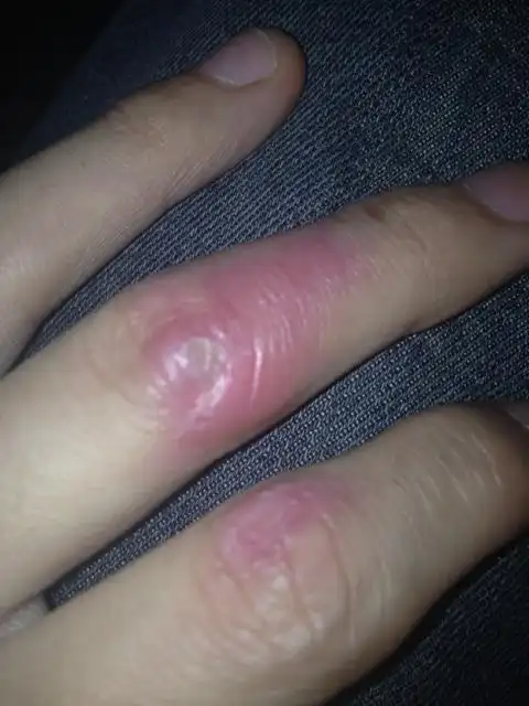 2013-12-06 22:53 提问者采纳 不明白的不要乱说,这种烫伤属于2度烧伤