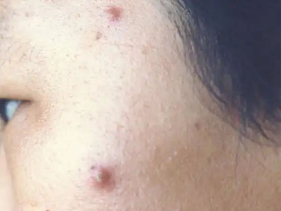 毛囊炎带来的问题是什么