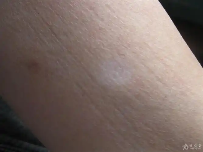 这是什么病---------斑状萎缩 - 皮肤及性传播疾病讨论版 - 爱爱医