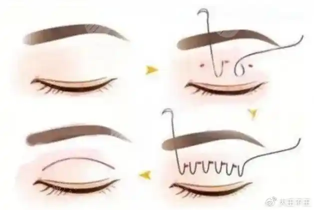 双眼皮种类全切和埋线哪种好?两种原理优势对比!