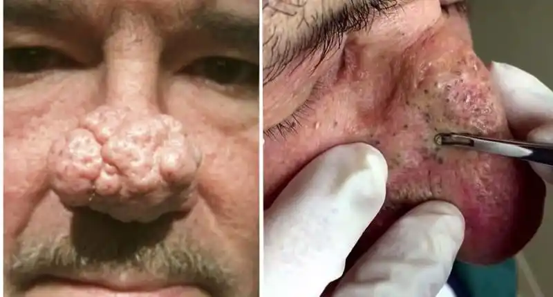 一口气挤掉鼻子上数之不尽的「黑头粉刺」居然是这种感觉.