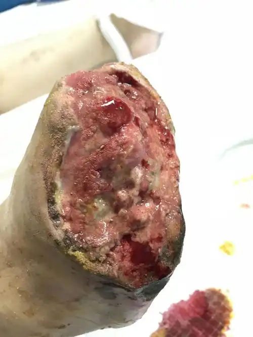 ▼下图患者为车祸致臀部脱套伤,软组织坏死,皮肤肌肉缺损,经植皮等