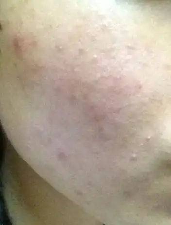 不知怎的就有脸上毛囊炎痘痘该用什么好呢?