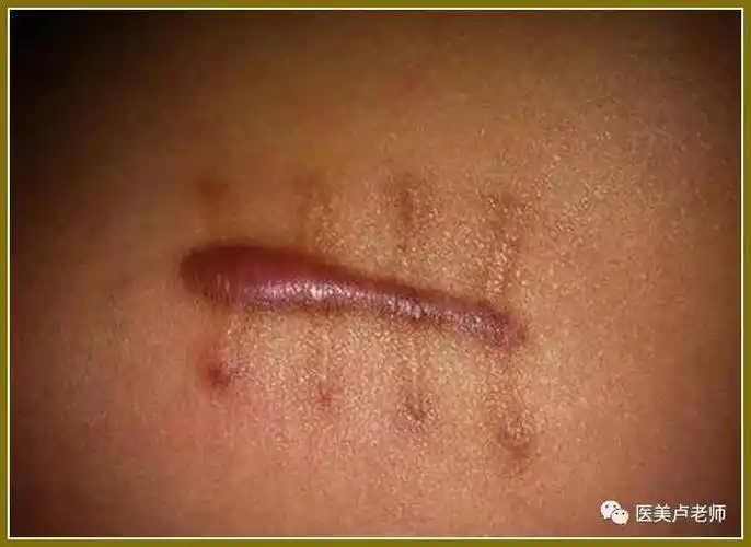外科手术以治疗病症为主,不注重伤口关闭的外在形状,手术伤口在长时间