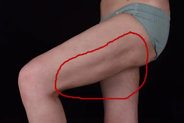 那些被吸脂毁掉的大腿附多图案例原创