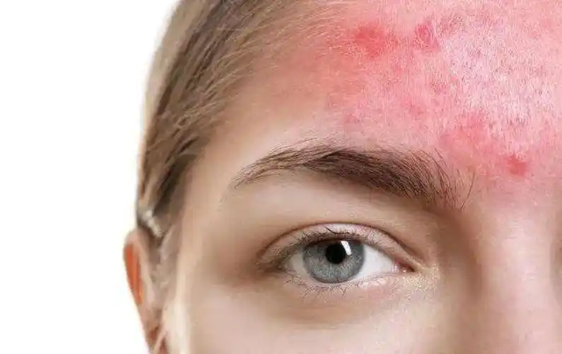 到底什么是皮肤屏障受损很多人理解错了难怪皮肤越来越差