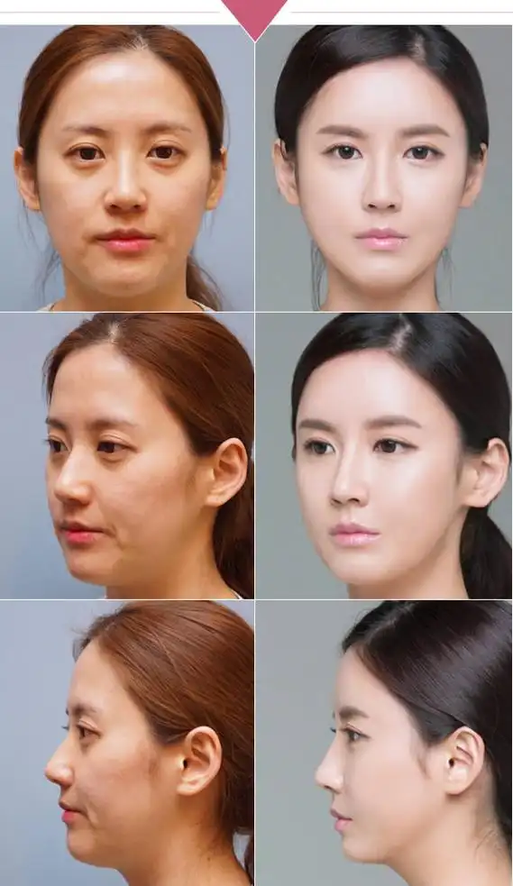 面部玻尿酸填充 效果极好