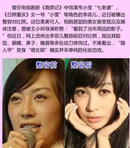 求李菲儿丑照及整容前后对比照