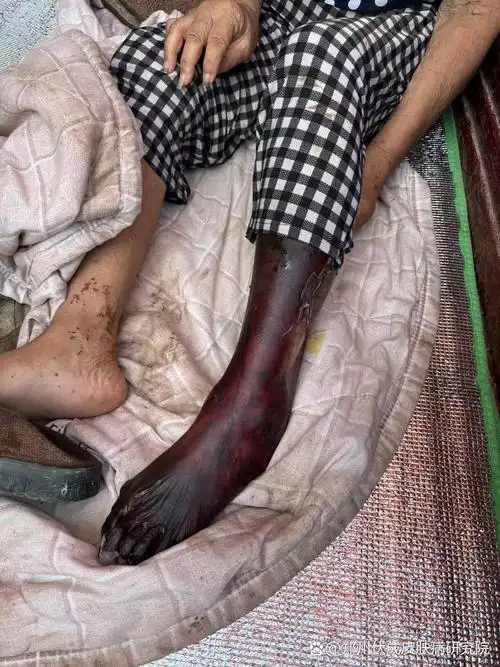 局部组织,液体成分,沿静脉回流局部形成,形成清楚的坏死区域.