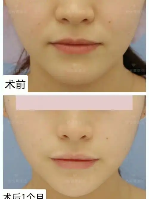 面部吸脂填充鼻基底术后1个月反馈