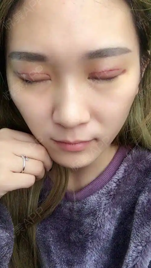 埋线双眼皮拆线视频