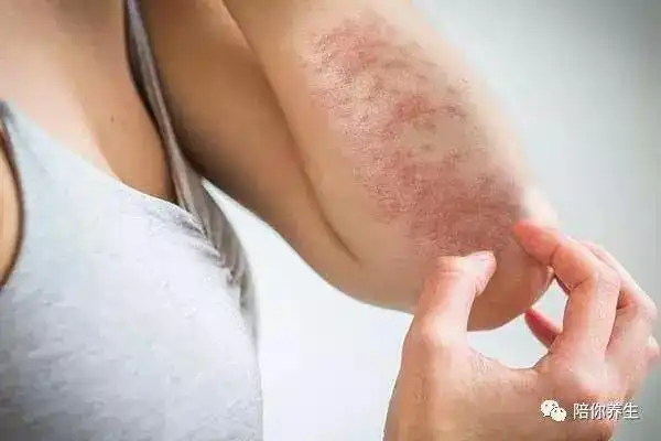 1,秋天皮肤容易痒 一挠就出现红疙瘩究竟是怎么回事