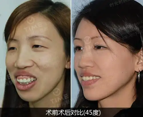 龅牙怎么办?_牙齿整形_第一整形美容网