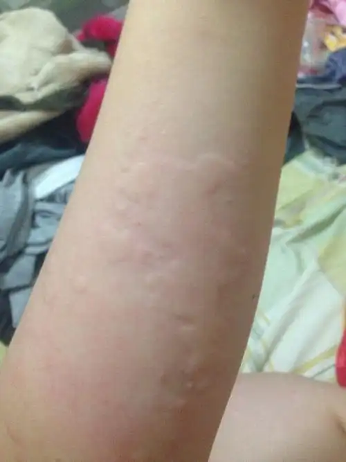 有人知道这是什么吗,晚上开始就长这种像蚊子包一样的东西,怎么消除